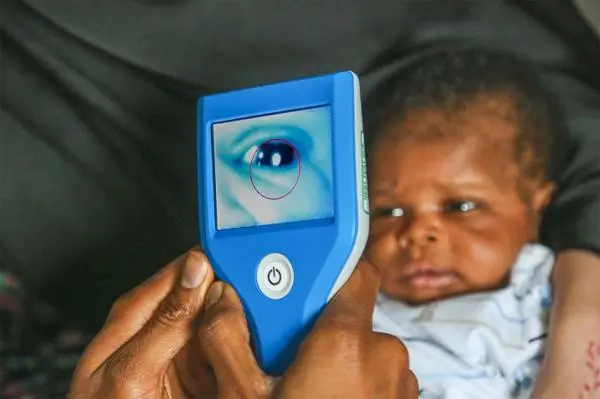 Blue, handheld Neocam device taking a picture of a baby's eye