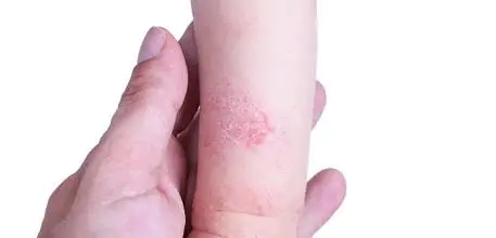 Patient with eczema