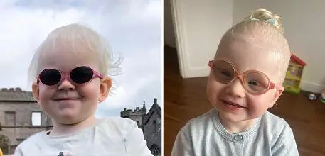 Raya and Amelia, who both have albinism