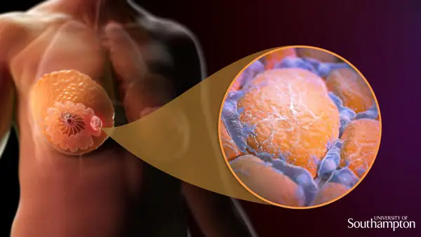 Breast tumour